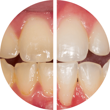 Before/After using Opalescence Go™